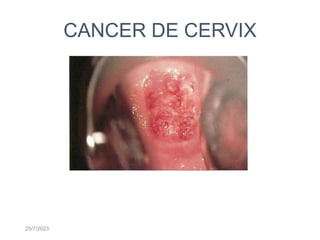 25/7/2023
CANCER DE CERVIX
ELENA MURIEL GOMEZ
 