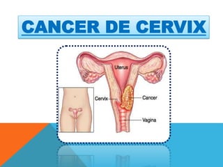 CANCER DE CERVIX
 