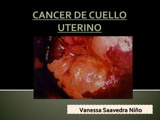 CANCER DE CUELLO UTERINO Vanessa Saavedra Niño 