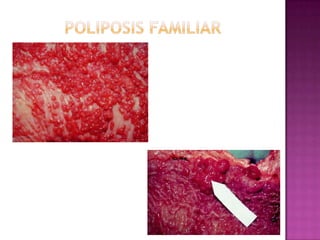 POLIPOSIS FAMILIAR