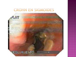 CROHN EN SIGMOIDES