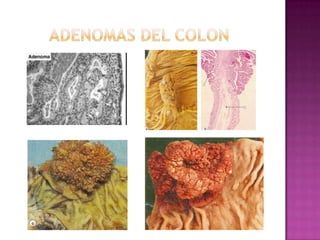 ADENOMAS DEL COLON