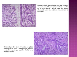 Histopatología de colon muestra  en el lado izquierdo un epitelio normal. Se encuentra un adenoma tubular en el lado derecho, benigno dado su epitelio diferenciado pero con núcleos hipercrómicos e irregulares.Histopatología de colon demuestra un pólipo adenomatoso de colon. Las glándulas se observan menos diferenciadas, por lo cual se clasifica como  neoplasia maligna