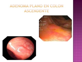ADENOMA PLANO EN COLON ASCENDENTE