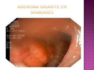 ADENOMA GIGANTE EN SIGMOIDES