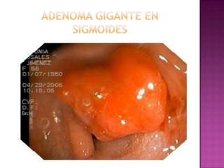 ADENOMA GIGANTE EN SIGMOIDES
