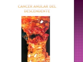 Cancer anular del descendente
