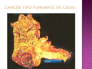 Cancer tipo fungante de ciego