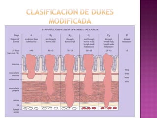 Clasificacion de dukes modificada