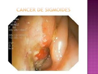 CANCER DE SIGMOIDES