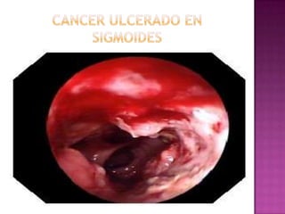 CANCER ULCERADO EN SIGMOIDES