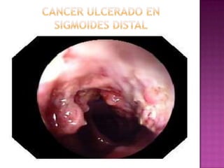 CANCER ULCERADO EN SIGMOIDES DISTAL