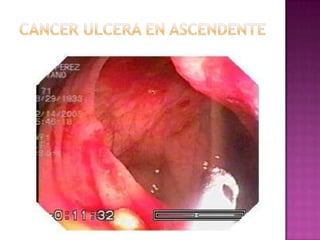 CANCER ULCERA EN ASCENDENTE