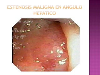 ESTENOSIS MALIGNA EN ANGULO HEPATICO