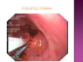 POLIPECTOMIA