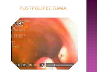 POSTPOLIPECTOMIA