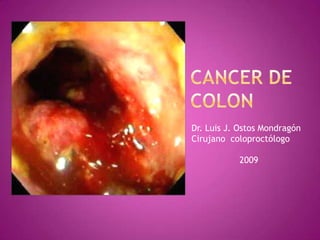 CANCER DE           COLON Dr. Luis J. Ostos Mondragón Cirujano  coloproctólogo                   2009 