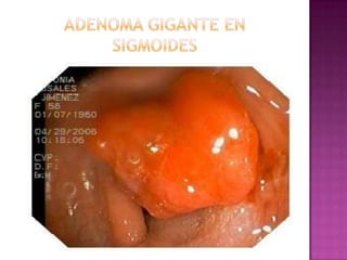 ADENOMA GIGANTE EN SIGMOIDES<br />