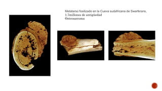 Costilla de Neandertal, Kaprina
Croasia
Displasia fibrosa
120,000años
 