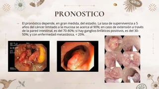 PRONOSTICO
⤞ El pronóstico depende, en gran medida, del estadio. La tasa de supervivencia a 5
años del cáncer limitado a la mucosa se acerca al 90%; en caso de extensión a través
de la pared intestinal, es del 70-80%; si hay ganglios linfáticos positivos, es del 30-
50%; y con enfermedad metastásica, < 20%.
 