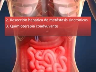 2. Resección hepática de metástasis sincrónicas
3. Quimioterapia coadyuvante
 