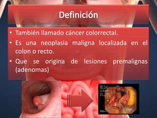 • También llamado cáncer colorrectal.
• Es una neoplasia maligna localizada en el
  colon o recto.
• Que se origina de lesiones premalignas
  (adenomas)
 