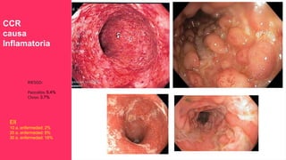 CCR
causa
Inflamatoria
RIESGO:
Pancolitis: 5.4%
Chron: 3.7%
EII
10 a. enfermedad: 2%
20 a. enfermedad: 8%
30 a. enfermedad: 18%
 
