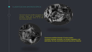 Carcinoma de tipo exofítico/fungante. El
volumen mayor de la neoplasia se
encuentra localizado hacia la luz del
tercio distal del recto.
Carcinoma endofítico/ulcerado. El recto muestra
una lesión ulcerada, excavada, con bordes irregulares y mal
delimitados. No hay crecimiento tumoral hacia la luz intestinal
CLASIFICACION AMCROSCOPICA
 