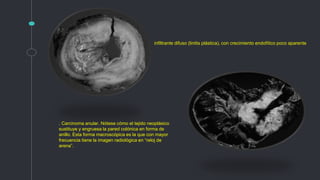 . Carcinoma anular. Nótese cómo el tejido neoplásico
sustituye y engruesa la pared colónica en forma de
anillo. Esta forma macroscópica es la que con mayor
frecuencia tiene la imagen radiológica en “reloj de
arena”.
infiltrante difuso (linitis plástica), con crecimiento endofítico poco aparente
 