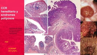 CCR
hereditario y
síndromes
poliposos
formación de lesiones
precursoras en forma
de adenomas o
hamartomas
PAF
CCRHNP
(sx Lynch)
 
