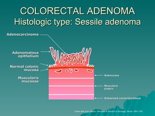 COLORECTAL ADENOMA
   Histologic type: Sessile adenoma
Adenocarcinoma




  Adenomatous
    epithelium


 Normal colonic
       mucosa
                                                   Submucosa
    Muscularis
     mucosae
                                                   Muscularis
                                                   propria


                                                   Subserosal connective tissue




                  Cohen AM, et al. Cancer: Principles & Practice of Oncology. 5th ed. 1997;1167.
 