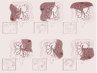 Cancer de colon y recto