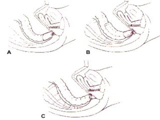Cancer de colon y recto