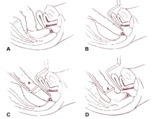 Cancer de colon y recto