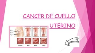 CANCER DE CUELLO
UTERINO
 