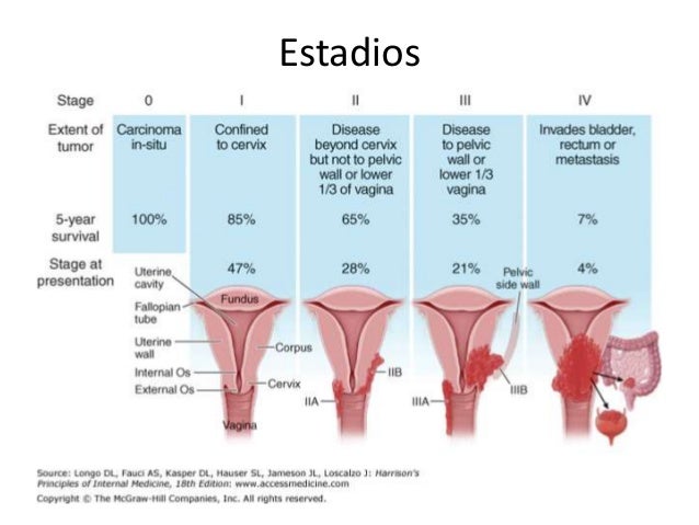 Cancer Cuello Uterino