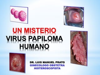 UN MISTERIO
VIRUS PAPILOMA
HUMANO
DR. LUIS MANUEL PRATO
GINECOLOGO OBSTETRA
HISTEROSCOPISTA
 