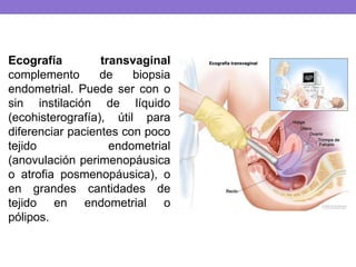Ecografía transvaginal
complemento de biopsia
endometrial. Puede ser con o
sin instilación de líquido
(ecohisterografía), útil para
diferenciar pacientes con poco
tejido endometrial
(anovulación perimenopáusica
o atrofia posmenopáusica), o
en grandes cantidades de
tejido en endometrial o
pólipos.
 