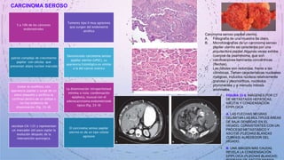 CARCINOMA SEROSO
5 a 10% de los cánceres
endometriales
Tumores tipo II muy agresivos
que surgen del endometrio
atrófico
patrón complejo de crecimiento
papilar con células que
presentan atipia nuclear marcada
Denominado carcinoma seroso
papilar uterino (UPSC), su
apariencia histológica es similar
a la del cáncer ovárico
tumor es exofítico, con
apariencia papilar y surge de un
útero pequeño y atrófico se
confinan dentro de un pólipo y
no hay evidencia de
diseminación (fig. 33-8).
La diseminación intraperitoneal
mínima o nula: condensación
epiploica, inusual con el
adenocarcinoma endometrioide
típico (fig. 33-9)
secretan CA-125 y representan
un marcador útil para vigilar la
evolución después de la
intervención quirúrgica.
El carcinoma seroso papilar
uterino es de un tipo celular
agresivo
• FIGURA 33-9. IMÁGENES POR CT
DE METÁSTASIS HEPÁTICAS,
ASCITIS Y CONDENSACIÓN
EPIPLOICA
• A. LAS FLECHAS NEGRAS
DELIMITAN LAS MÚLTIPLES ÁREAS
DE BAJA DENSIDAD EN EL
HÍGADO, CONSISTENTES CON UN
PROCESO METASTÁSICO Y
ASCITIS (FLECHAS BLANCAS
CURVAS) ALREDEDOR DEL
HÍGADO.
• B. UNA IMAGEN MÁS CAUDAL
REVELA LA CONDENSACIÓN
EPIPLOICA (FLECHAS BLANCAS)
Carcinoma seroso papilar uterino.
A. Fotografía de una muestra de útero.
B. Microfotografías de un carcinoma seroso
papilar uterino se caracteriza por una
arquitectura papilar.Algunas veces exhibe
cuerpos de psammoma, que son
calcificaciones laminares concéntricas
(flechas).
C. Las células son redondas, frente a las
cilíndricas. Tienen características nucleares
malignas, incluidos núcleos relativamente
grandes y pleomórficos, nucléolos
prominentes y a menudo mitosis
anormales.
 