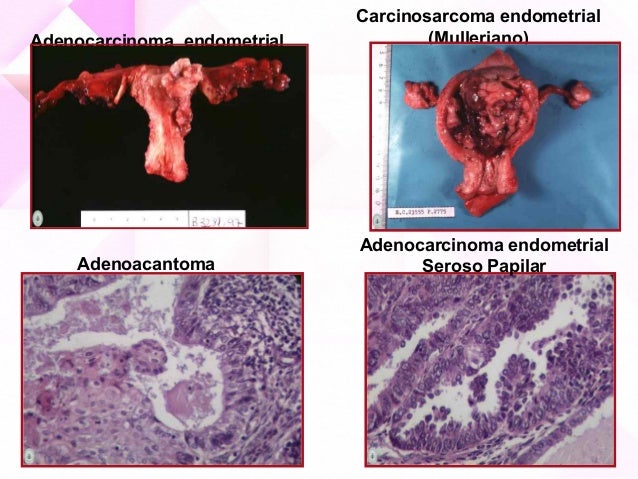 cancer-de-endometrio-abrs