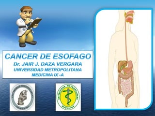 CANCER DE ESOFAGO Dr. JAIR J. DAZA VERGARA UNIVERSIDAD METROPOLITANA MEDICINA IX -A 