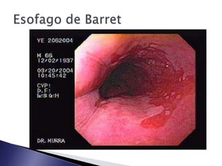 Hallazgo histopatológico: