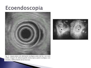 Además el ca epidermoide y el adenoca tienen distintas características en cuanto al tipo de paciente y su condición nutricional, carcinogénesis, localización, etc.Tipo Histológico