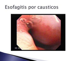 Esofagitis por causticos
