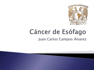 Cáncer de Esófago Juan Carlos Campos Álvarez 