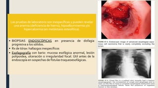 Las pruebas de laboratorio son inespecíficas y pueden revelar
una anemia (deficiencia de hierro), hipoalbuminemia y/o
hipercalcemia (en metástasis osteolítica).
de disfagia
• BIOPSIAS ENDOSCÓPICAS en presencia
progresiva a los sólidos.
• Rx de tórax: hallazgos inespecíficos
• Esofagografía con bario: mucosa esofágica anormal, lesión
polipoidea, ulceración o irregularidad focal. Útil antes de la
endoscopía en sospechas de fístulas traqueoesofágicas.
 