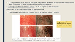  TC: engrosamientos de la pared esofágica, irregularidad, estenosis focal con dilatación proximal o
masa intraluminal así como lesiones metastásicas, linfadenopatías.
Endoscopía de alta resolución con biopsia para dx de displasia y cáncer temprano.
Puede variar de mucosa normal, a úlceras, nódulos y masas.
 FISH mejora el rendimiento de citología para dx de adenocarcinoma y displasia.
Imágenes de banda
estrecha detectan cambios
en vasculatura y superficie.
 
