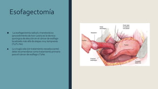 Esofagectomía
■ La esofagectomía radical y transtorácica
(procedimiento de Ivor-Lewis) es la técnica
quirúrgica de elección en el cáncer de esófago
localizado más allá de etapas muy tempranas
(T1/T2 N0)
■ La cirugía sola (sin tratamiento neoadyuvante)
debe recomendarse como tratamiento primario
para el cáncer de esófago cT2N0
 