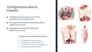 Esofagectomía abierta
estándar
■ Esofagectomía transtorácica Ivor-lewis
(abordaje torácico-abdominal)
■ Esofagectomía McKeown (abordaje torácico-
abdominal-cervical)
■ Esofagectomía transhiatal (abordaje
abdominal-cervical)
Esofagectomía mínimamente invasiva
• Esofagectomía toracoscópica
• Procedimiento de Ivor-lewis por
movilización de laparoscopia gástrica
• Toracotomía derecha abierta
 