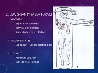 Cancer De Esofago Y Acalasia Tratamiento Quirurgico PPT Cancer De Esofago Y Acalasia Tratamiento Quirurgico PPT